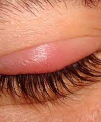Arpacik Sorunu Icin Dogal Tedaviler Gozun Etrafinda Sisme Varsa Arpacik Cikmis Olabilir Genellikle Agri Yapma Eye Stye Remedies Blepharitis Dry Skin Remedies