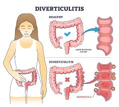 Image result for Diverticulitis