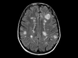 Multiple sclerosis (ms) is a relatively common acquired chronic relapsing demyelinating disease involving the central nervous system, and is the second most common cause of neurological impairment in young adults, after trauma 19.characteristically, and by definition, multiple sclerosis is disseminated not only in space (i.e. Mri Scan Of The Brain In A Patient With Multiple Sclerosis Showing Download Scientific Diagram