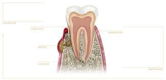 Einschneiden von Abszessen - Cichoń Dental Centre