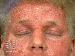 Image result for ekzema face