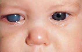 الجلوكوما Alkaff Clinics عيادات الكاف