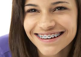 Maybe you would like to learn more about one of these? How Much Do Braces Cost Mv Ortho