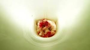 Blut im stuhl tritt häufig in zusammenhang mit schmerzen beim stuhlgang auf. Blut Im Stuhl Durch Hamorrhoiden Youtube