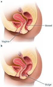 Image result for Vaginal Pooling