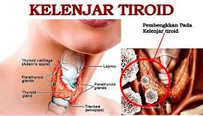 Penyakit tiroid adalah penyakit yang menyerang kelenjar tiroid. Kelenjar Tiroid Posts Facebook