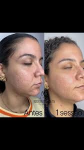 Jato De Plasma Em Cicatriz Processus