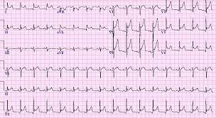 Entzündungen am herzenin diesem podcast werden systematisch myokarditis, endokarditis und perikarditis erläutert. Physical Activity Recommendations In Patients With Acute Pericarditis American College Of Cardiology