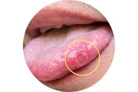 Image result for cancer of tongue