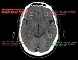 Schau dir angebote von postmortem post mortem auf ebay an. Estimation Of Time Of Death Using Brain Parenchyma Attenuation In Post Mortem Computed Tomography Of Brain In Malaysian Setting Sciencedirect