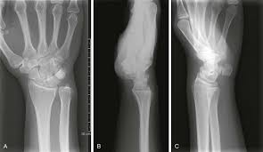 Image result for Wrist XRay