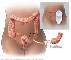 It is an organ that is part of the digestive system (also called the digestive tract) in the human body. Colon Cancer Diagnosis And Treatment Mayo Clinic