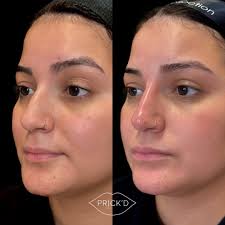Non-surgical nose job with filler 💉 Here's what to expect: 𝗖𝗢𝗡𝗦𝗨𝗟𝗧  — we'll talk through your goals (lifted tip, straighter bridge, smoothing  small bumps) and make sure they're realistic + safe 💬