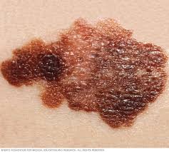 سرطان الجلد الأعراض والأسباب mayo clinic مايو كلينك