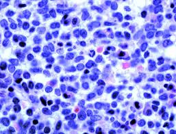 We did not find results for: Bone Marrow Aspirate And Biopsy Case 171
