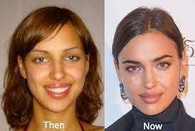 Born 6 january 1986), known as irina shayk (/ʃeɪk/; Pin Von Sedef Berscheid Auf Cosmetic Surgery Plastische Chirurgie Prominente Plastische Chirurgie Fettabsaugung