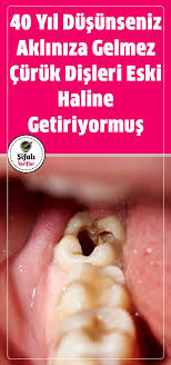 40 Yil Dusunseniz Akliniza Gelmez Curuk Disleri Eski Haline Getiriyormus Belfast Queen S Universitesi Kuzey Irlanda Nin En Dis Dogal Saglik Bitkisel Tarifler