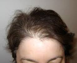 Myths And Facts Help Hair Loss Hair Transplant Cost Hair Loss