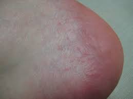 Men utslett på kroppen kan oppstå som følge av en allergisk reaksjon på noen produkter, materialer hvis du ser utslett på barnets albuer,kanskje det er bare en manifestasjon av svette. Fot Utslett Rode Prikker Helse Diskusjon No