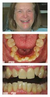 The Academy for Clear Aligner Therapy American Academy of Clear Aligners