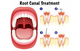 The pain in your tooth might bother you all the time, or it might go away from time to time but always return. 6 Symptoms That You Need Root Canal Treatment