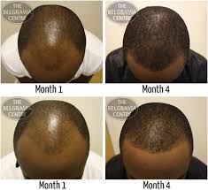 Here, learn how to thin out hair with the help of your stylist, as well as 6 other tips for making thick hair appear thinner. As A Black Man Will Hair Loss Treatments Work For My Hair