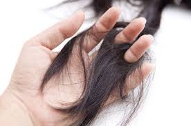 Esmerlerde 120 Bin Sarisinlarda Ise 140 Bin Adet Sac Teli Vardir Her Gecen Gun Basimizdan 25 000 Arasi Reduce Hair Loss What Causes Hair Loss Summer Hair Care