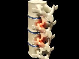 They are the small joints that help you bend and twist. Facet Syndrome Effective Treatment Sussex Back Pain Clinic