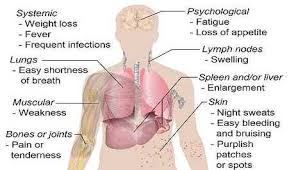 The symptoms of hematologic malignancies (blood cancer) are usually generalized and vague, often including effects such as bruising, fevers, chills, and if you have blood cancer, it's important that you learn how to recognize the symptoms and complications, as well as the side effects of your treatment. Leukemia In Children Blood Cancer Cancer Cancer Cancer Chemo En En En Health Amp Fitness Glogster Edu Interactive Multimedia Posters