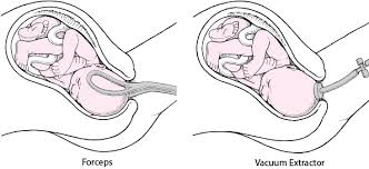 Image result for Forceps Assisted Delivery