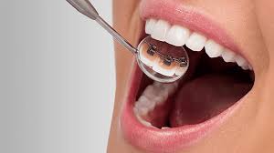 Lingual Braces Dubai | Straighten Your Teeth Naturally