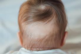 Most experts agree that hair loss is due to decreased hormone levels; Baby Hair Loss A Guide For New Parents Littleonemag