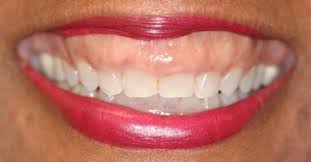 Teeth covered by excessive gum tissue appear short also, the manner in which your upper jaw bone grew and developed could cause the appearance of a gummy smile. The 4 Main Causes Of A Gummy Smile Explained