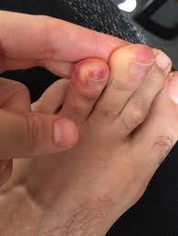 Image result for Chilblains