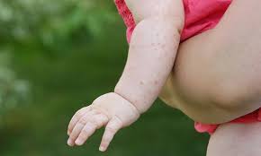Image result for sweat rash on back baby