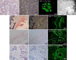 Congo red positivity remains the gold standard for diagnosis of amyloidosis. Plos One Utility Of Abdominal Skin Plus Subcutaneous Fat And Rectal Mucosal Biopsy In The Diagnosis Of Al Amyloidosis With Renal Involvement