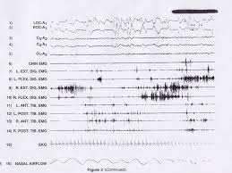 Image result for REM Sleep Behavior Disorder