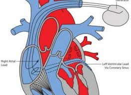 A heart pacemaker with the capability of monitoring and stimulating both the atria and/or the ventricles when necessary. Set A Pace For Better Implantable Defibrillator Coding Aapc Knowledge Center