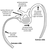 Image result for icd 10 code for mild thoracic scoliosis