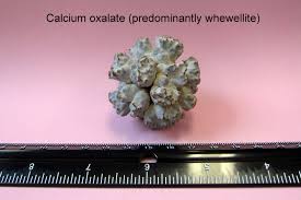 Calcium Oxalate Predominantly Whewellite Calcium Renal Calculi Microbiology