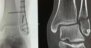 Lindsey vonn, marcel hirscher, lee chong wei, javier fernandez: Dxylryjmv3nwrm