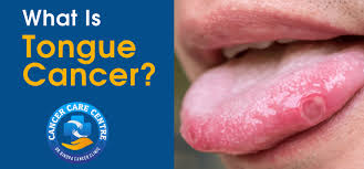 Image result for cancer tongue symptoms)