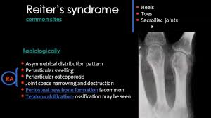 Pin By Dr Abuaiad On Bone And Joints Bone And Joint Sacroiliac Sacroiliac Joint