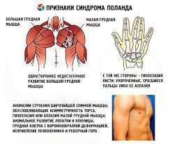 普拉達威利症候群 (pws):主要21個國家的市場預測 (2018～2028年) epiomic epidemiology series: æ³¢è˜­ç¶œåˆç—‡ åœ¨iliveä¸Šä¸»ç®¡å¥åº·