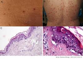 Most rashes are caused by common viral infections, and are nothing to be worried about. Cutaneous Manifestations In Patients With Covid 19 Clinical Characteristics And Possible Pathophysiologic Mechanisms Actas Dermo Sifiliograficas
