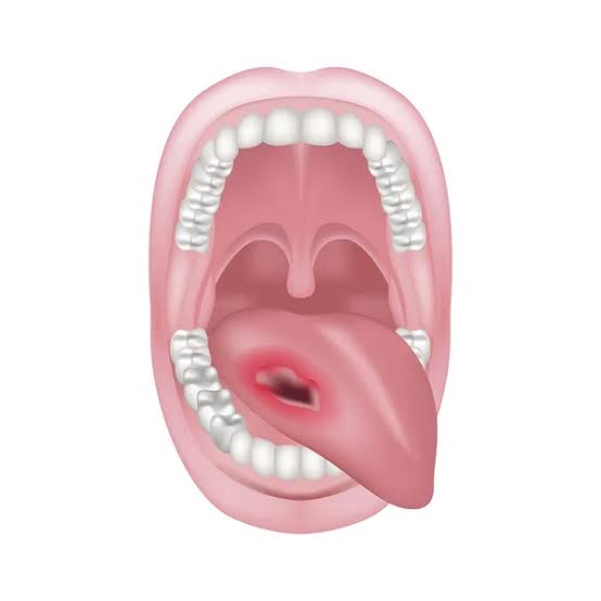 202 ilustraciones de stock de Cancer bucal | DepositPhotos