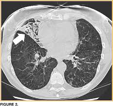 Lady Windermere Syndrome Treatment