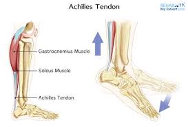 Achilles Tendinopathy Physiopedia