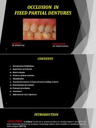 Which type of occlusion should be avoided in kennedy class 2 rpd. 6 Occlusion In Fpd Human Tooth Dentistry Branches