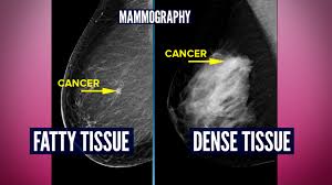 Simone said, mammograms increase the risk for developing breast cancer and raise the risk of when the inevitable results with a positive cancer diagnosis, we are treated like a victim. Do You Have Dense Breasts You May Need More Than A Mammogram